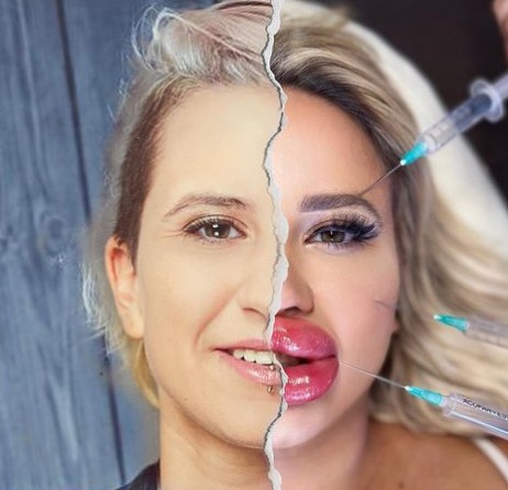 Jessy Bunny Plastic Surgery: Transforming Into a Human Barbie Doll