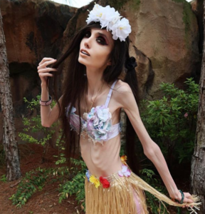 Eugenia Cooney's Weight Loss: Before And After, Anorexia Nervosa And